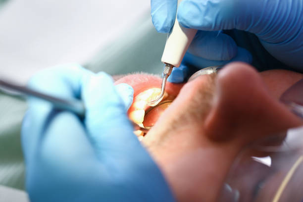 Best Emergency Root Canal Treatment in Highwood, IL
