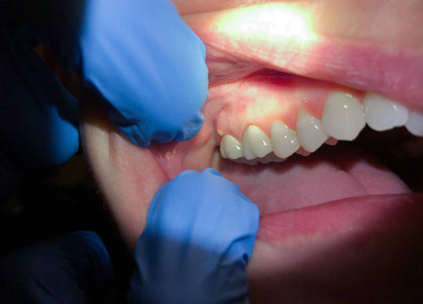 Best Emergency Tooth Extraction in Highwood, IL