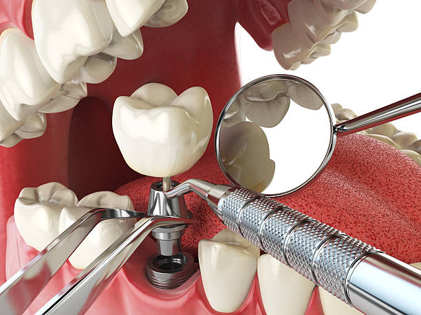 Best Emergency Tooth Extraction in Highwood, IL